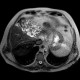 Varicose dilation of the biliary ducts in the left liver lobe, unknown origin: MRI - Magnetic Resonance Imaging